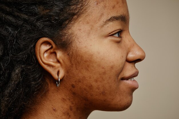 Dark spots and hyperpigmentation